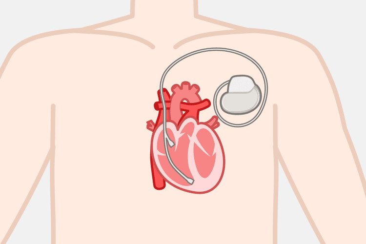 ペースメーカーのイメージイラスト